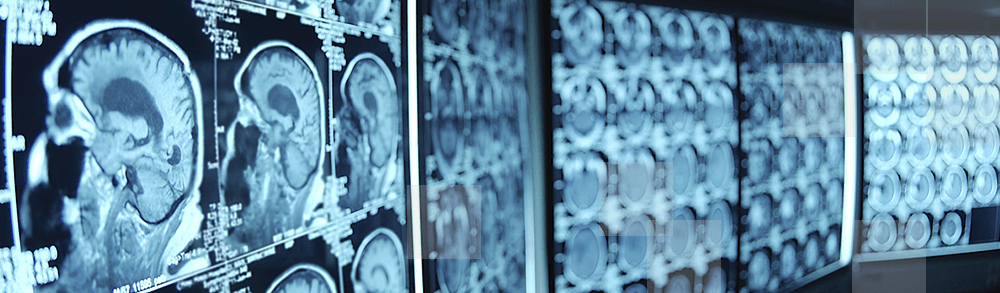 How NLP Is Unlocking Data Driven Insights for Radiologists