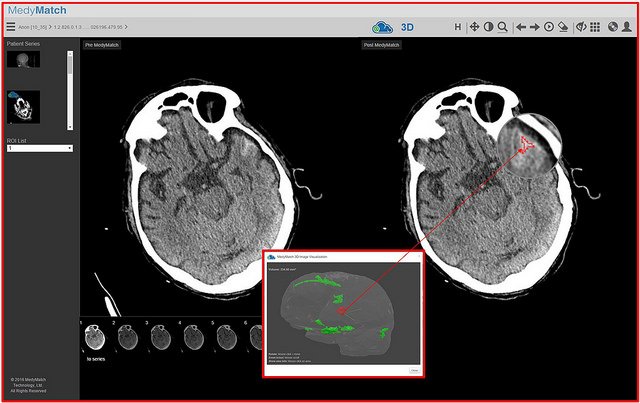 IBM Watson Health Integrates with MedyMatch’s A.I. Platform to Help Doctors Identify Head Trauma and Stroke