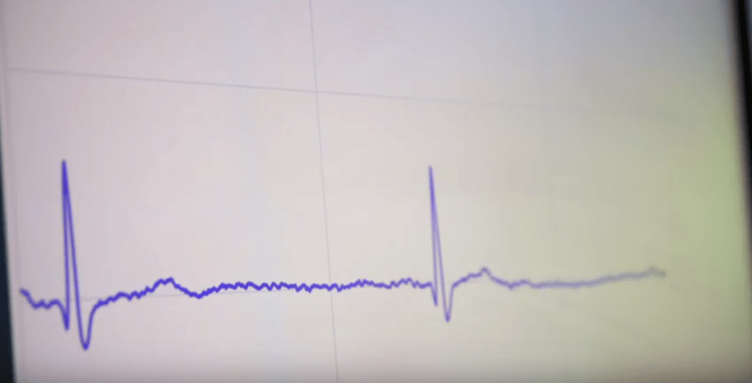 Stanford researchers develop algorithm to diagnose heart arrhythmias