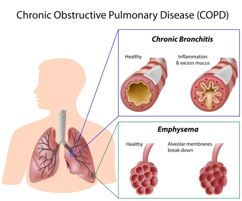 HGE Health, Change Healthcare Partner on Value-based COPD Care Transformation