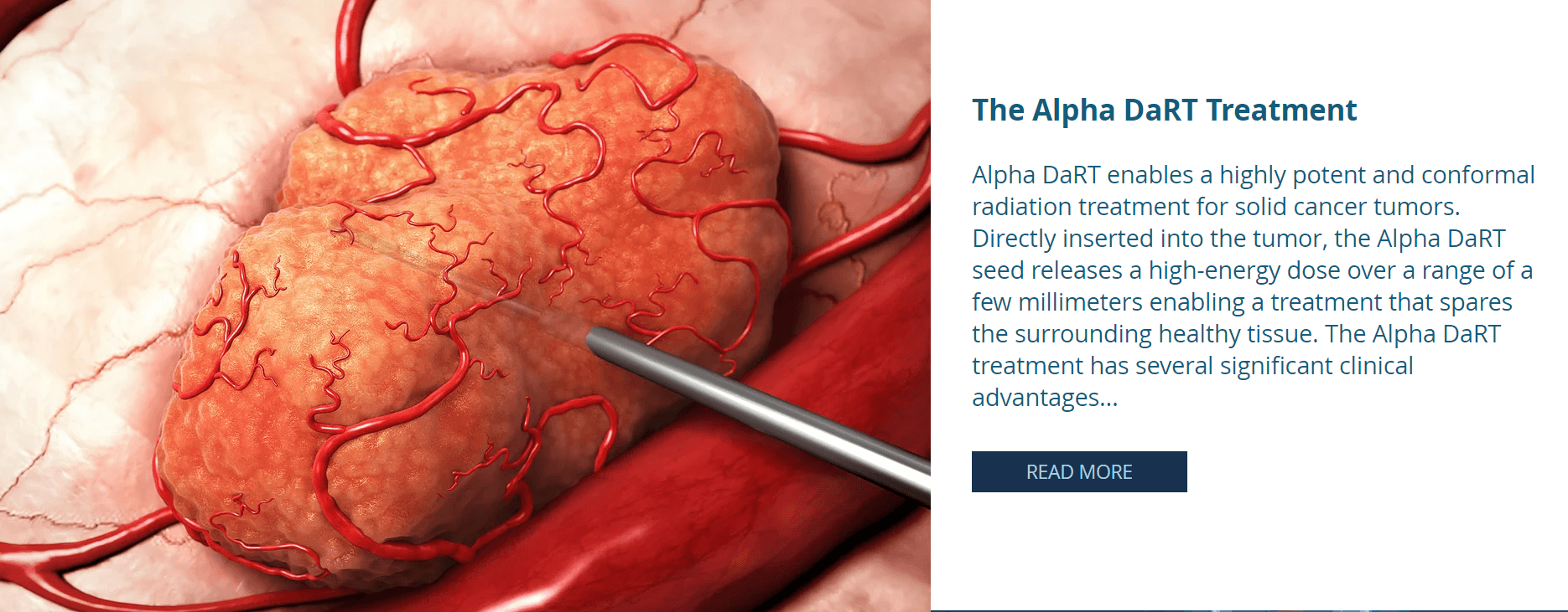 Israeli Startup Alpha Tau Medical Raises $29M for Radiation Cancer Therapy