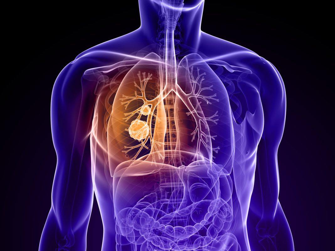 AdoRx Therapeutics, J&J Team Up to Develop Novel Lung Cancer Therapeutics