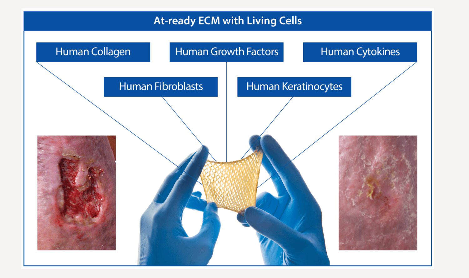 Misonix Acquires Regenerative Wound Healing Product Theraskin for $97M