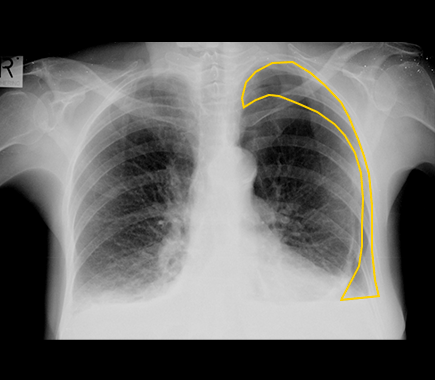 Zebra Medical Vision Granted FDA 510k Clearance for AI Chest X-Ray Triage 