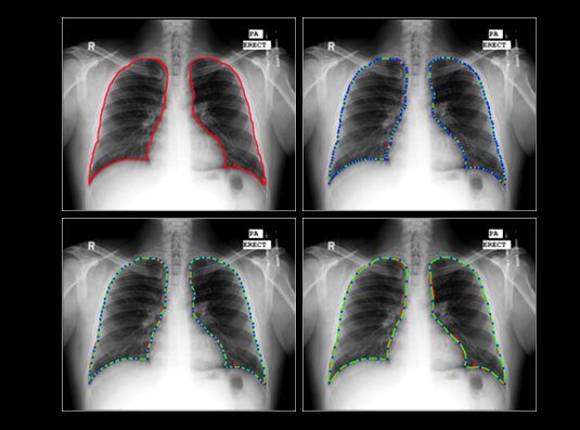 AI vs. Humans: AI Solution Beats Stanford Radiologists in Chest X-ray Diagnostics Competition