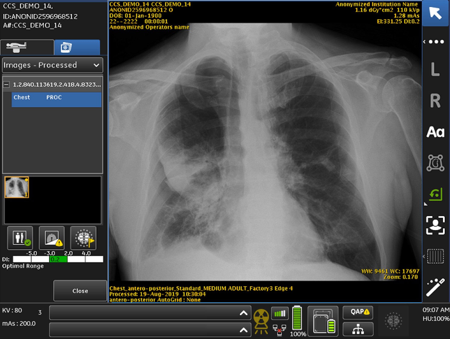 GE Healthcare Receives FDA Clearance of First Artificial Intelligence Algorithms Embedded On-Device to Prioritize Critical Chest X-ray Review