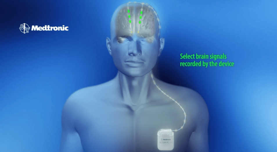 medtronic dorsal column stimulator surgery