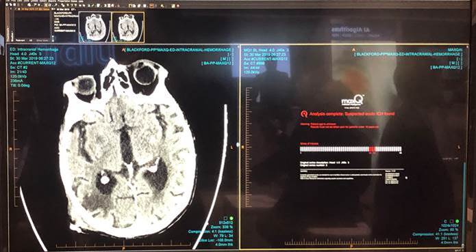 MaxQ AI to Offer Intracranial Hemorrhage (ICH) AI Software Apps on Blackford Platform