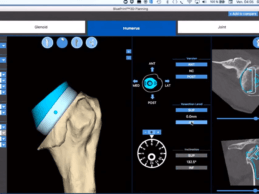 Mayo Clinic Performs First Shoulder Arthroplasty Procedure Using Mixed Reality