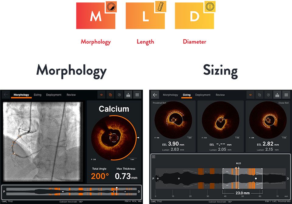 Abbott Launches New Coronary AI-Powered Imaging Platform in Europe