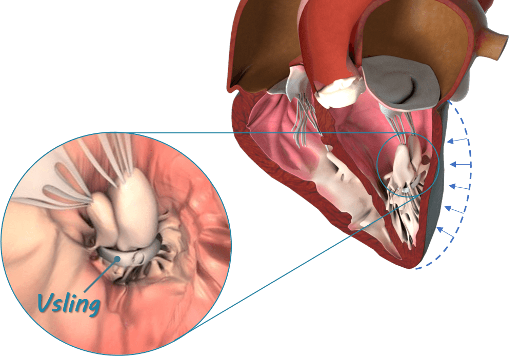 Cardiac Success Secures $5.2M for Transcatheter Ventricular Repair Device for Heart Failure Patients