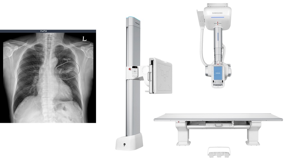 VUNO Inks Deal with Samsung to Integrate AI Chest X-Ray with Samsung’s Digital Radiography System