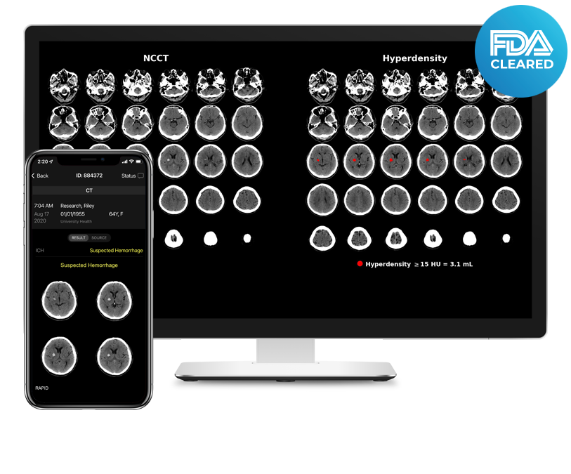 RapidAI Awarded FDA Clearance for AI Powered CT Scans to Identify Intracerebral Hemorrhage