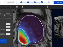 Avenda Health Receives FDA Exemption for AI-Enabled Prostate Cancer Therapy