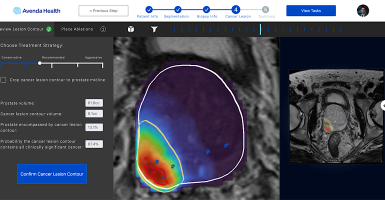 Avenda Health Receives FDA Exemption for AI-Enabled Prostate Cancer Therapy