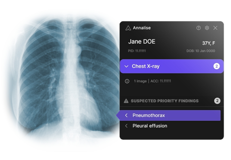 Annalise.ai Launches AIPowered Worklist Triage for Chest XRay & Head CTs