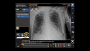 RNSA23: GE Healthcare Awarded FDA Clearance for Pneumothorax Detection Algorithm