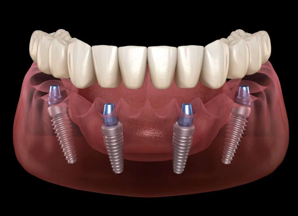 Discover the Game-Changer in Dental Restoration: The All-On-4 Implant