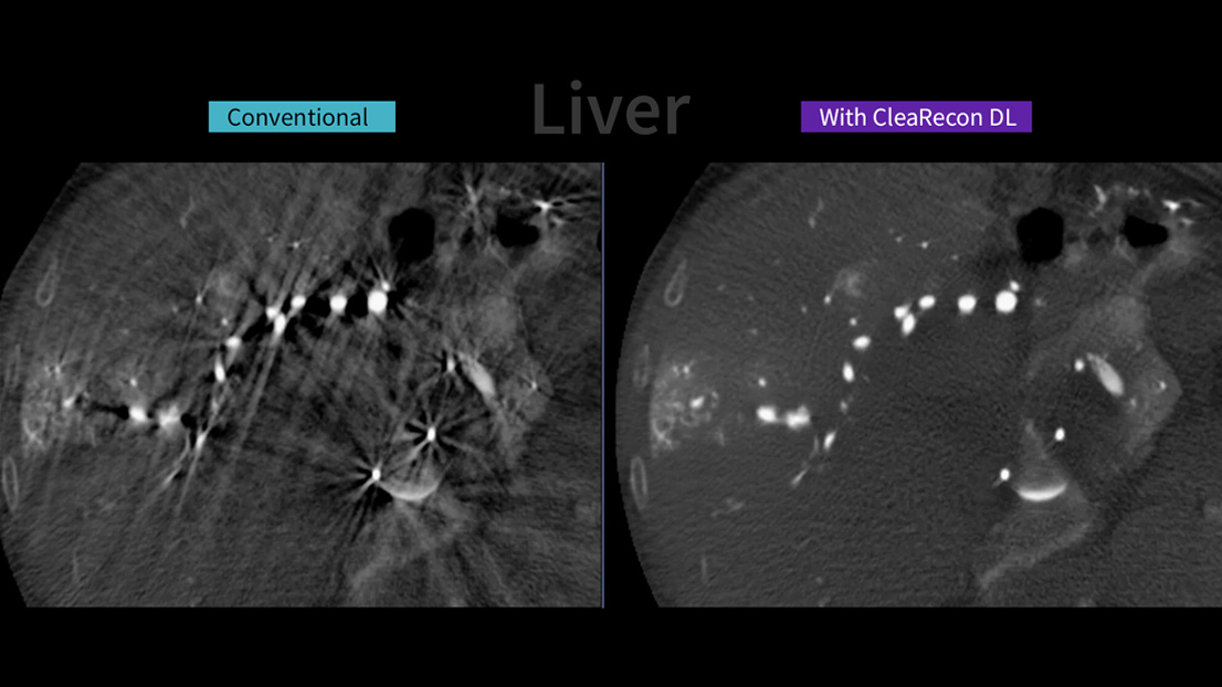 GE HealthCare Launches AI-Powered CleaRecon DL to Enhance CBCT Image Quality in Interventional Procedures