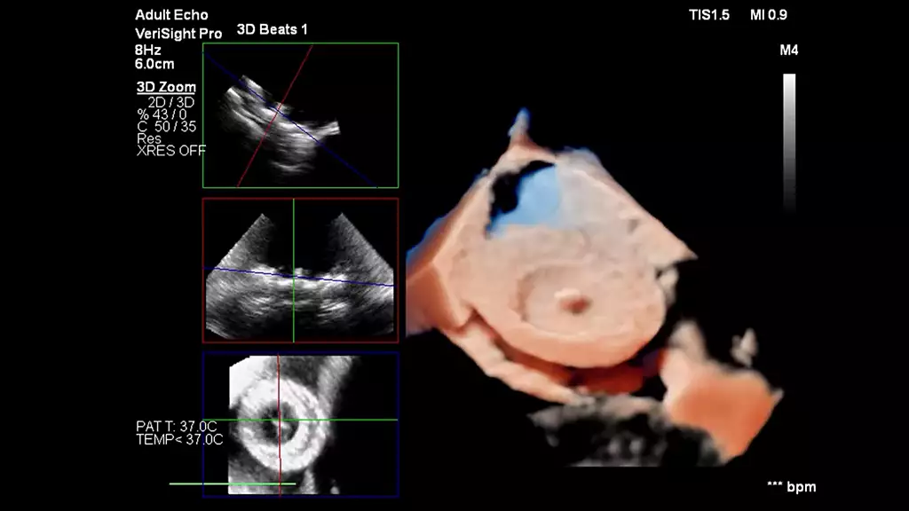 Philips Launches VeriSight Pro 3D Intracardiac Echo Catheter in Europe