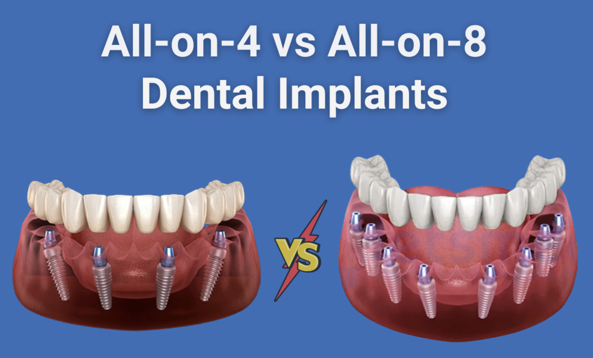 All-on-4 vs. All-on-8 Dental Implants: Which is Right for You?