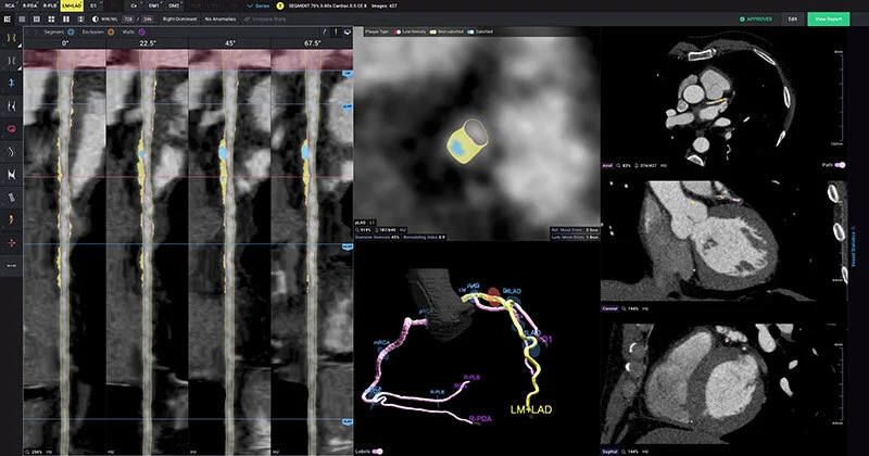 Cigna to Cover Cleerly’s AI-Based Cardiovascular Imaging