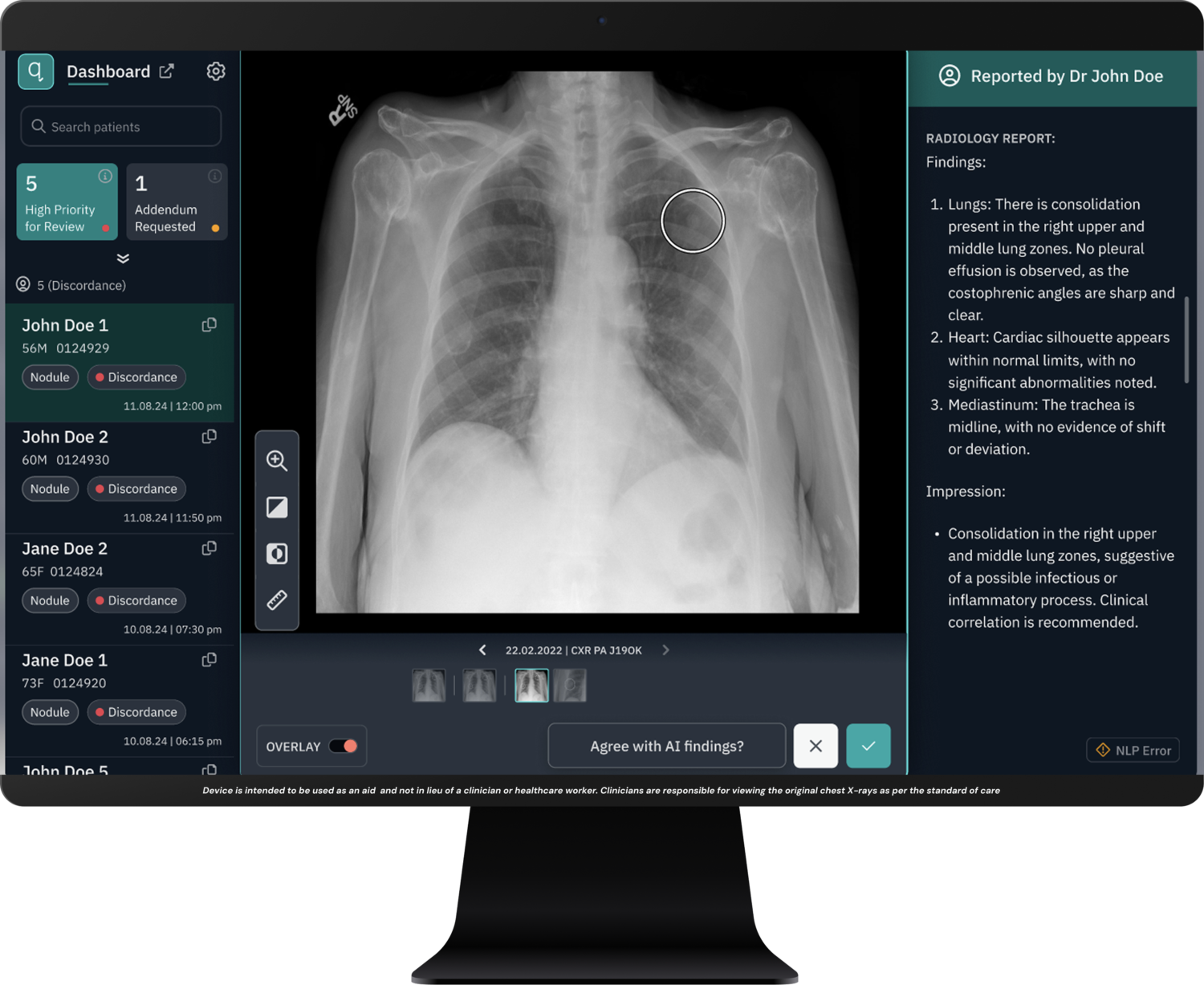 How Horizon Health and Qure.ai Are Using AI to Catch "Incidental" Lung Cancer