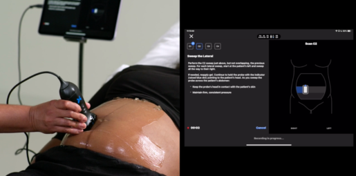 Butterfly Network Receives FDA Clearance for AI-Powered Gestational Age Ultrasound Tool