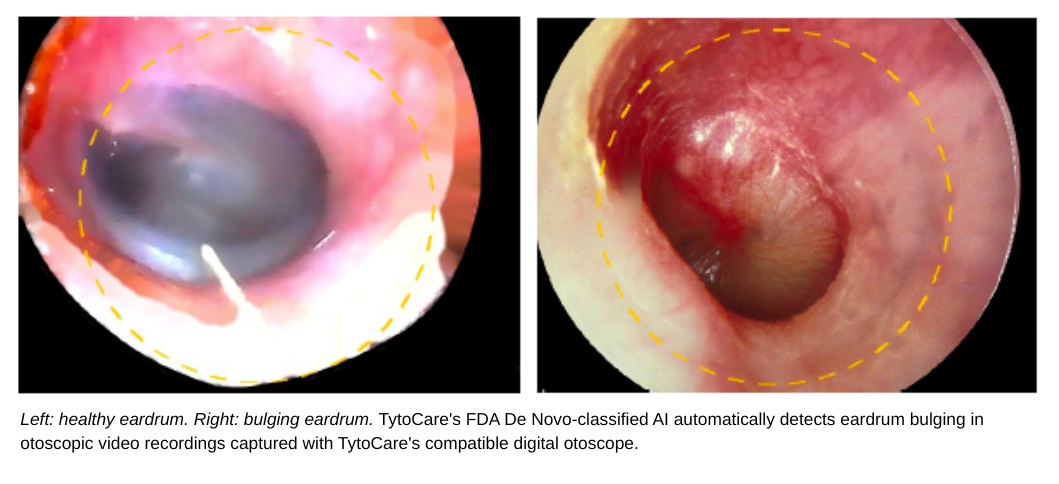 TytoCare Receives FDA De Novo Classification for Tyto Insights ENT Suite AI Image Analysis