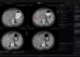 Raidium Launches AI-Native Radiology Platform in the U.S. at Moffitt Cancer Center