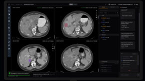 Raidium Launches AI-Native Radiology Platform in the U.S. at Moffitt Cancer Center