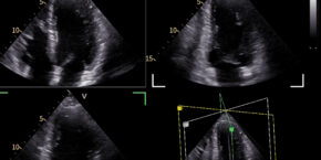 GE HealthCare Expands Cardiovascular Ultrasound Portfolio with Vivid Explorer, Vivid Advanced, and Vivid Focus
